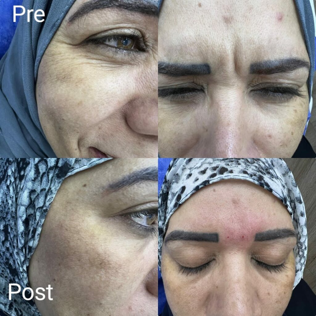 بوتكس الوجه